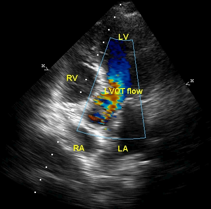 Apical five chamber view view with color flow mapping showing the blue coloured flow from the left ventricle converging to the left ventricular outflow tract