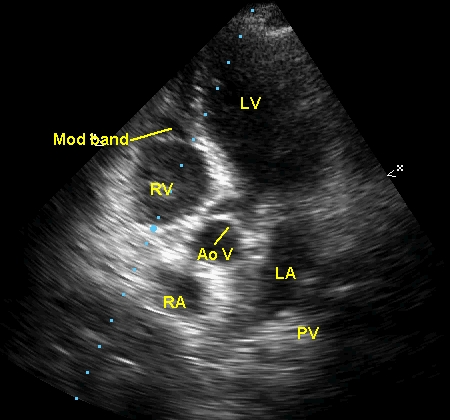 Apical five chamber view showing the aortic valve and moderator band