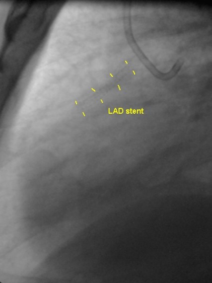 Stent outline seen on fluoroscopic image in lateral view