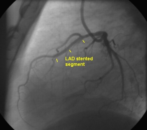 Stented segment of LAD in lateral view of coronary angiography