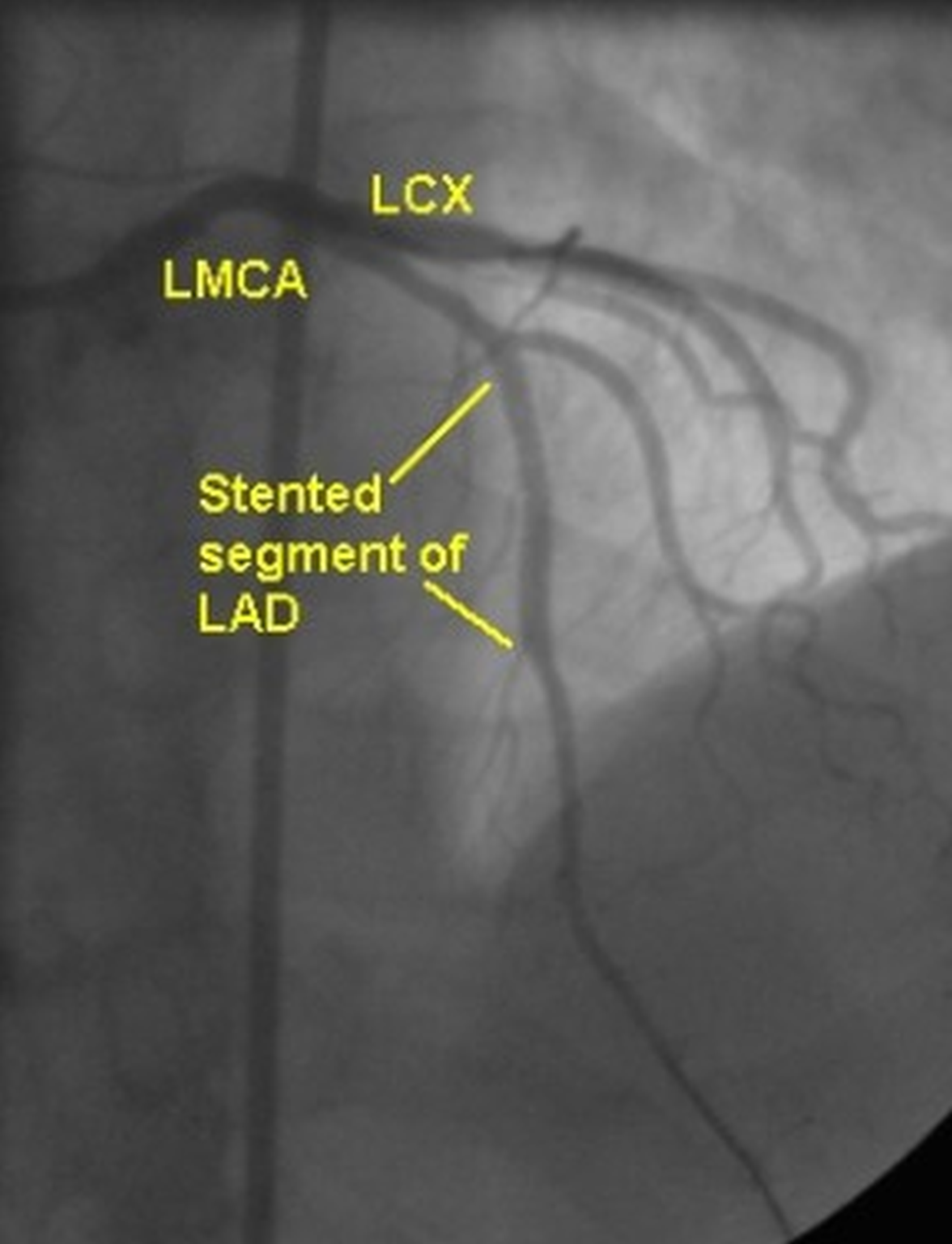 PTCA stenting of LAD total occlusion – All About Cardiovascular System ...