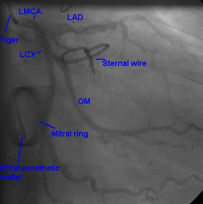 Prosthetic mitral leaflet in RAO caudal view