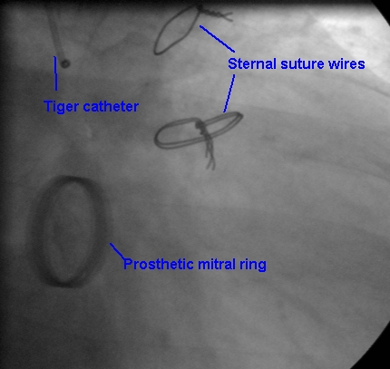 Prosthetic mitral valve ring seen on fluoroscopy in the RAO caudal view