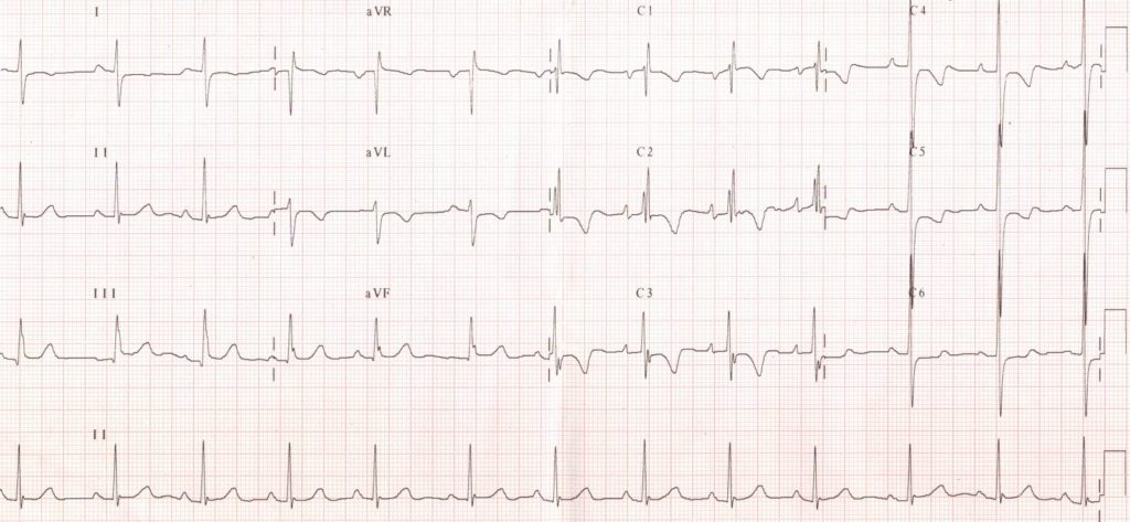 RBBB and LVH