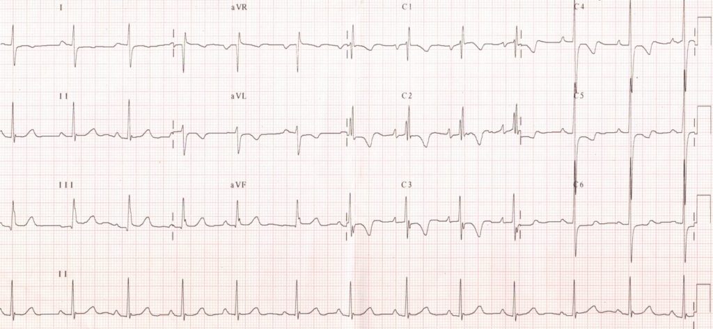 Right bundle branch block and left ventricular hypertrophy
