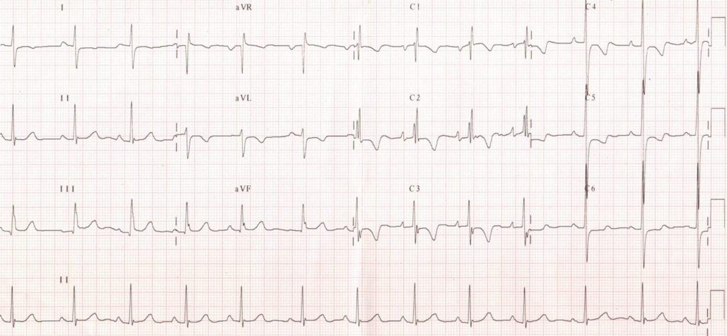 Right bundle branch block and left ventricular hypertrophy