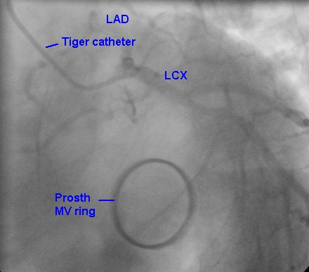 Valve ring of prosthetic mitral valve - closed position