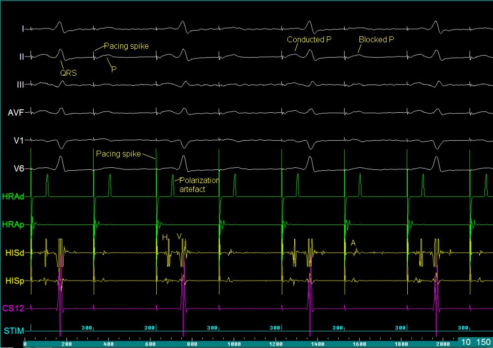 Atrial pacing with 2:1 AV block - EP tracing