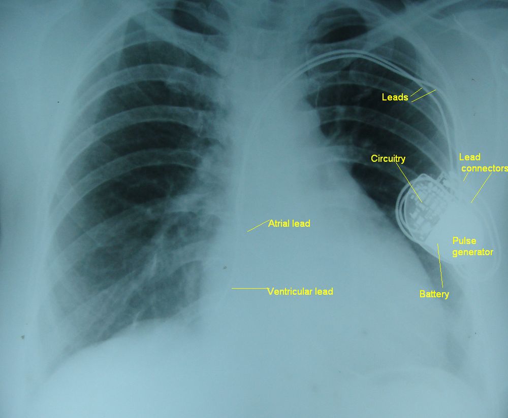 Dual chamber pacemaker with leads on a chest x-ray