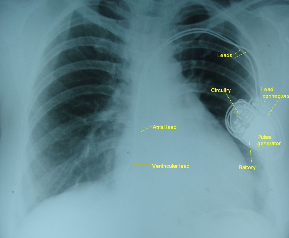 Pacemaker Electrode Placement Radiology At Beau Eardley wilmot Blog