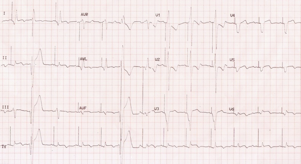 ECG in cardiac resynchronization therapy (CRT)