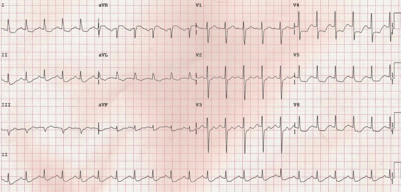 ECG in left main coronary artery stenosis