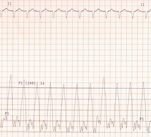 ECG and pressure tracing on IABP