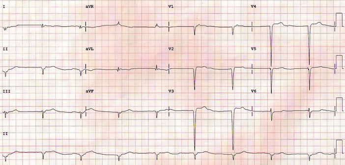 Junctional rhythm, inferior and anterior wall infarction