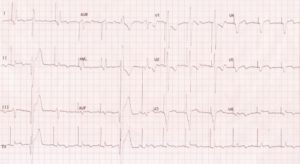 combo-device-ECG-SMALL – All About Cardiovascular System and Disorders