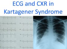 ECG and CXR in Kartagener Syndrome
