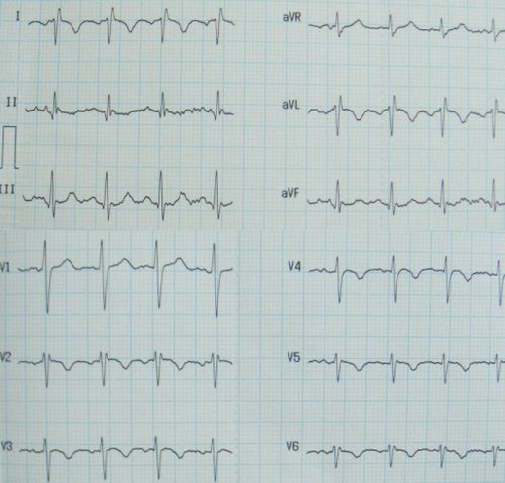 ECG in Kartagener syndrome showing features of dextrocardia