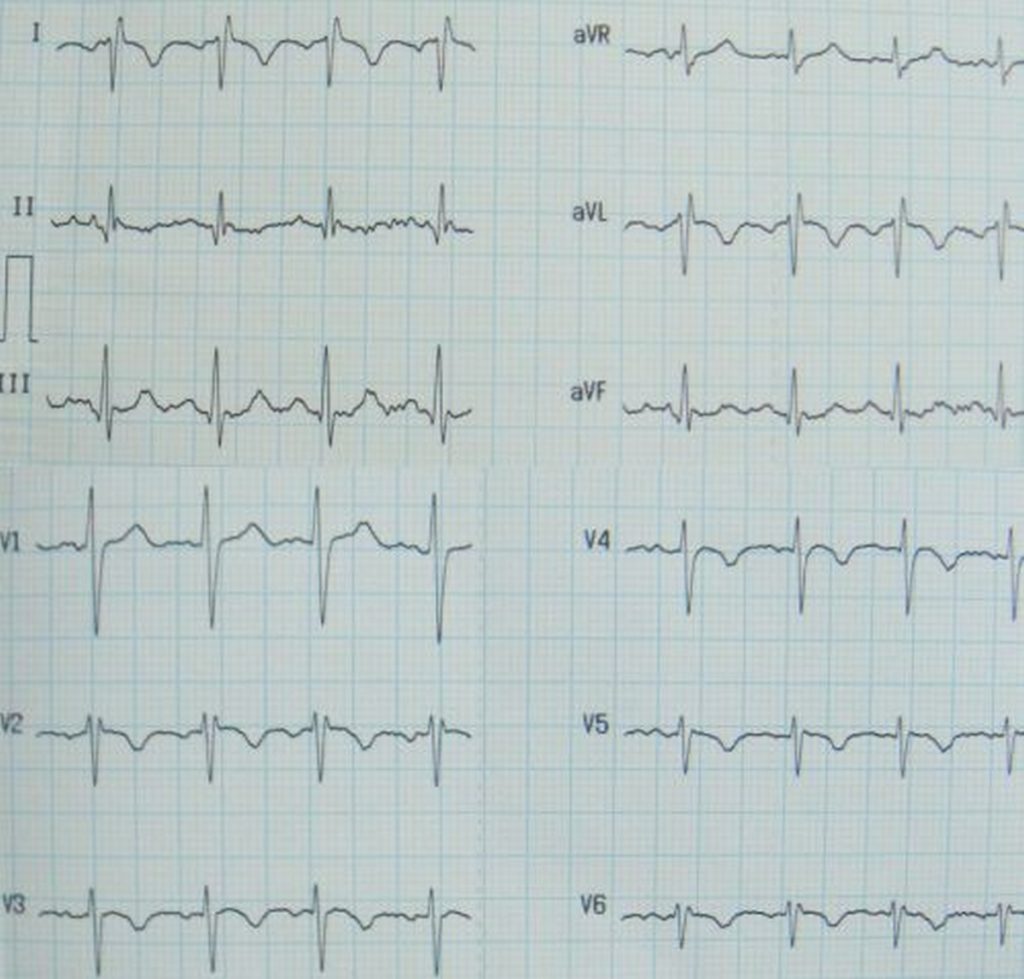 Kartagener Syndrome Dextrocardia Situs Inversus Immotile Cilia