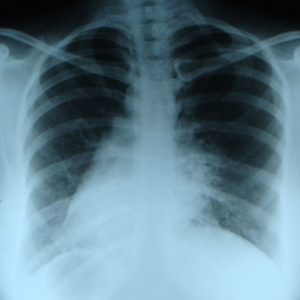 Kartagener Syndrome - dextrocardia, situs inversus, immotile cilia