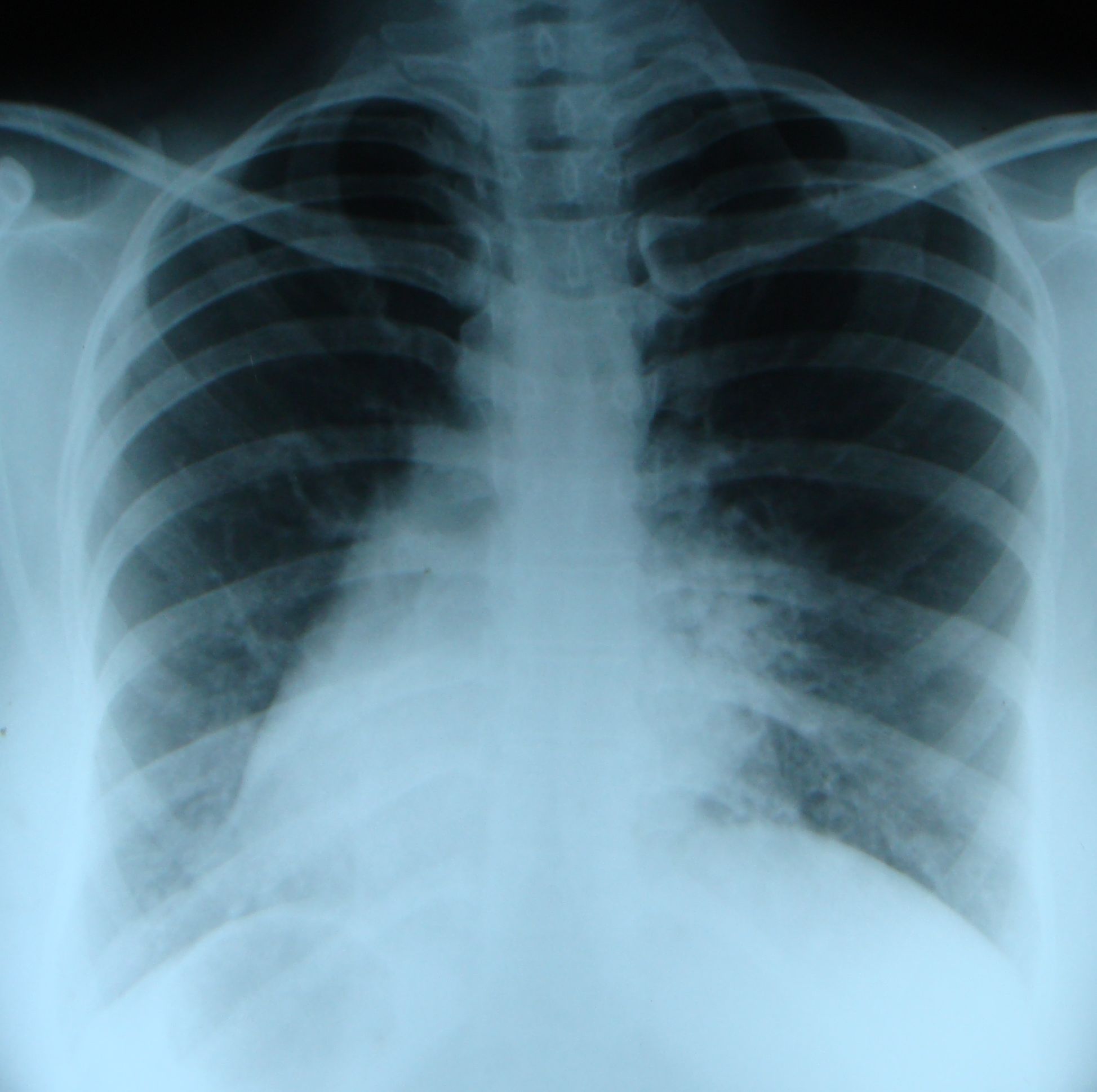 X-ray Chest PA view in Kartagener's syndrome