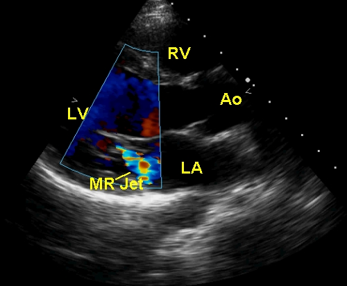 Colour Doppler echocardiogram in parasternal long axis view showing mitral regurgitation (MR)