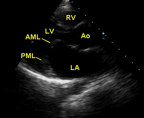 Echocardiogram in rheumatic mitral stenosis (post balloon mitral valvotomy)