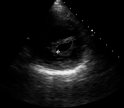 Parasternal short axis view in mitral stenosis after balloon mitral valvotomy