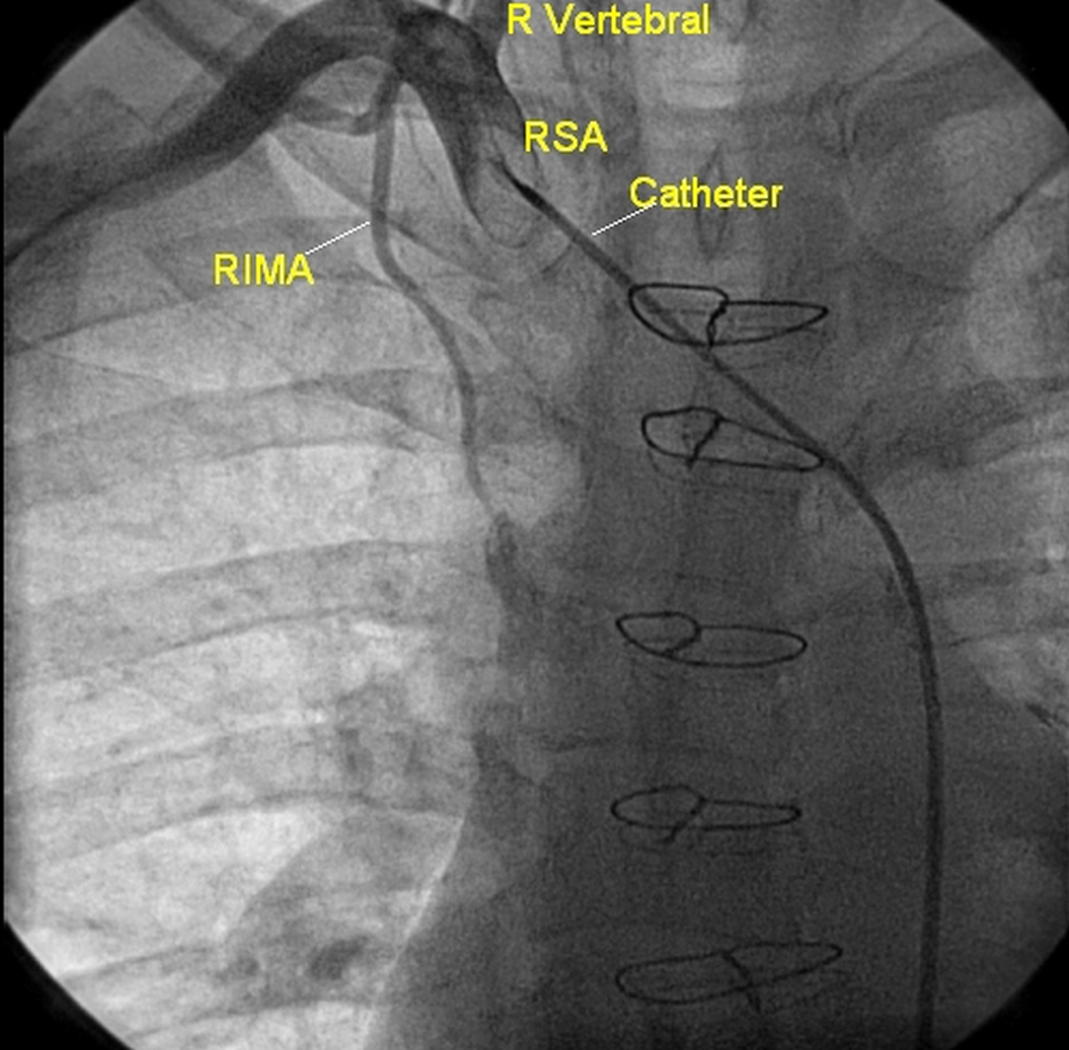 Right internal mammary artery (RIMA) angiogram