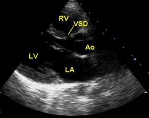 VSD-PLAX – All About Cardiovascular System and Disorders