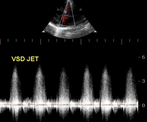 Continuous wave Doppler interrogation of VSD jet