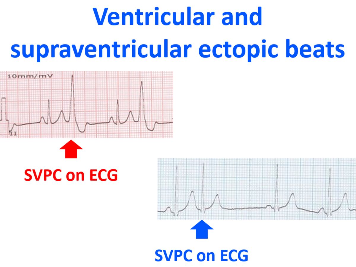 atrial and ventricular ectopy