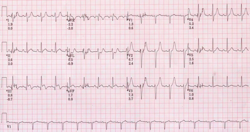 TMT recovery at 2 minutes showing ST elevation in inferior leads and mild ST depression in lead I and II