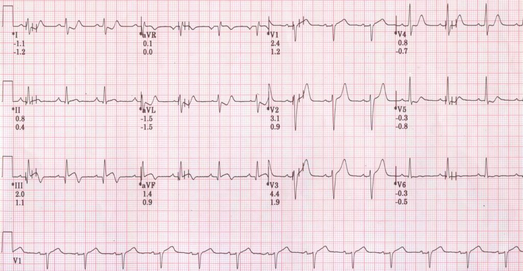 TMT recovery at 6 minutes showing ST elevation in inferior leads and mild ST depression in lead I and II