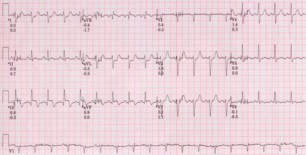 TMT stage 1 showing ST elevation in inferior leads and ST depression in lead I and II