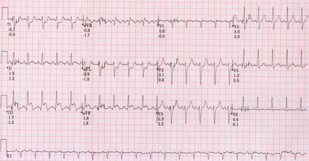 TMT stage 2 showing ST elevation in inferior leads and ST depression in lead I and II