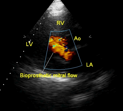 Fairly laminar across a bioprosthetic mitral valve in parasternal long axis view