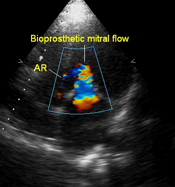 Bioprosthetic mitral flow as seen from apical four chamber view