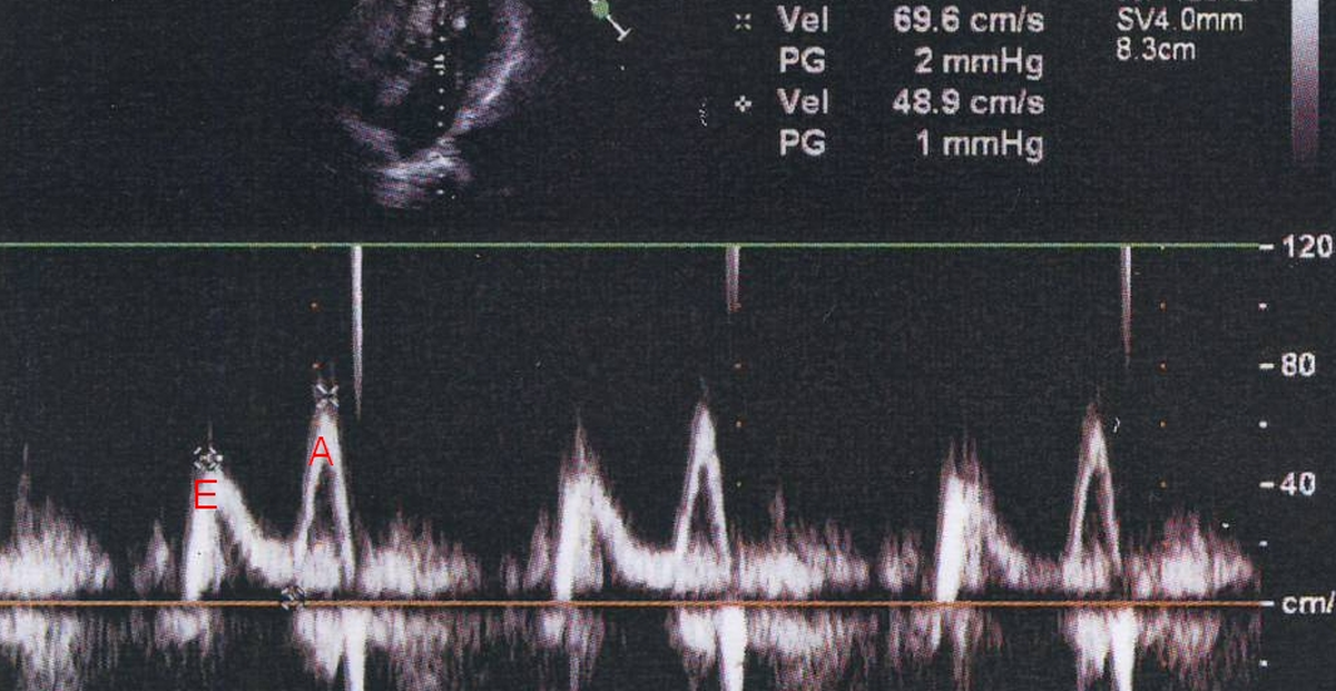 Mitral E/A reversal in LVEMF