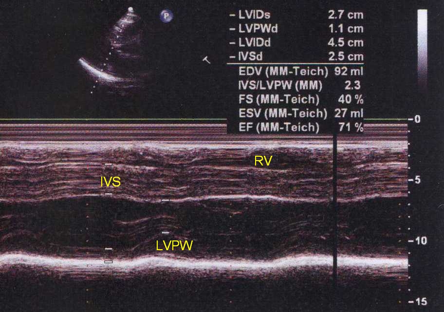 M-Mode echocardiogram in hypertrophic cardiomyopathy