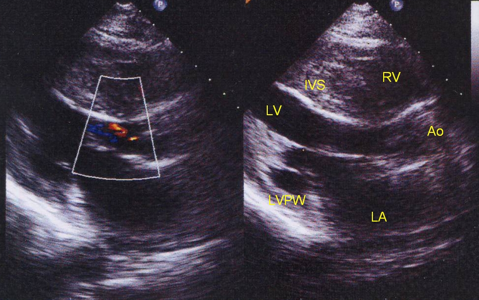 Echocardiogram in hypertrophic cardiomyopathy, parasternal long axis view