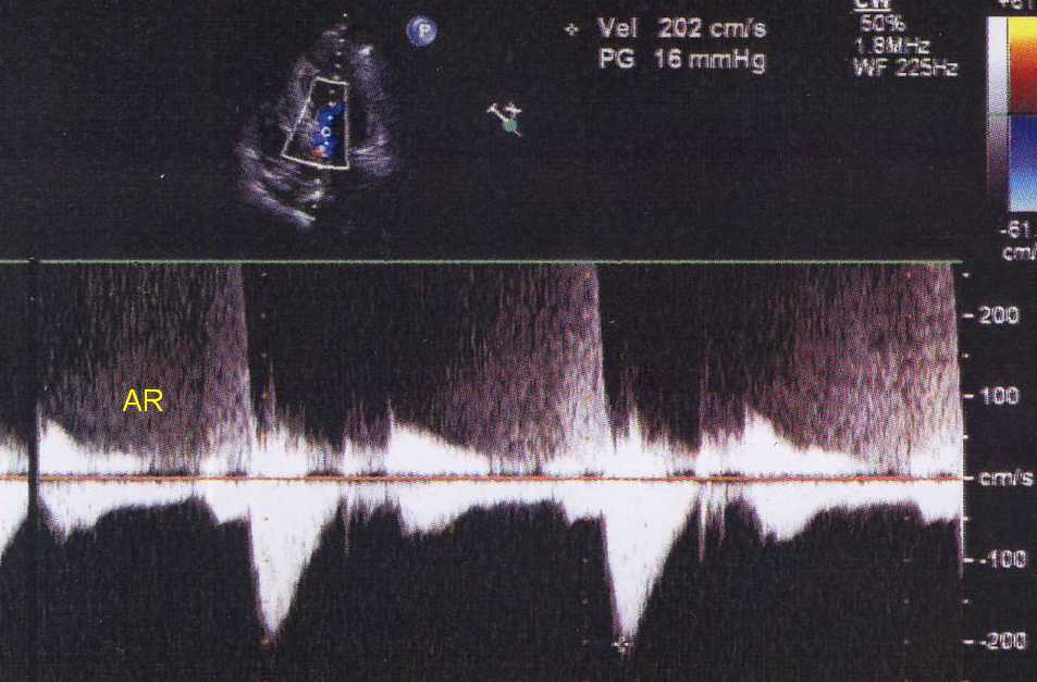 HCM with mild AR seen on continuous wave Doppler