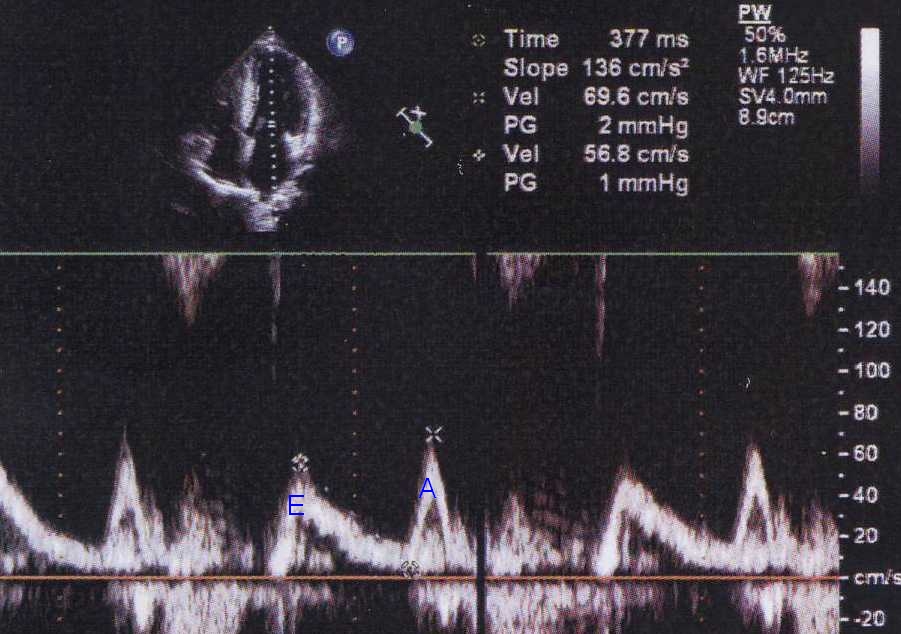 Mitral inflow Doppler tracing in HCM showing E/A reversal