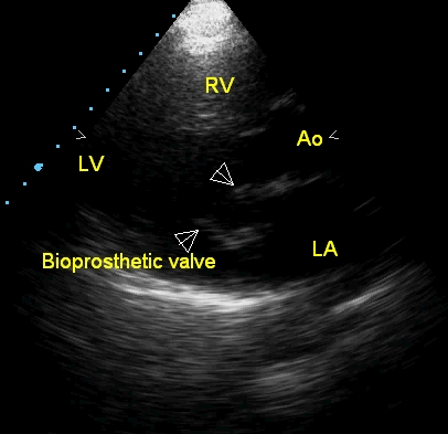 Echocardiogram of bioprosthetic mitral valve in parasternal long axis view 