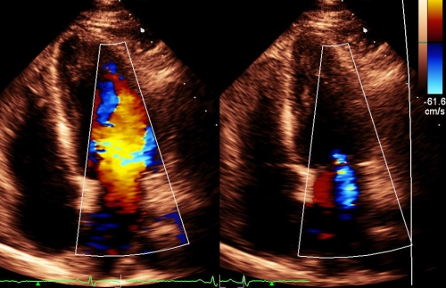 Colour Doppler of mitral flow - diastolic and systolic frames