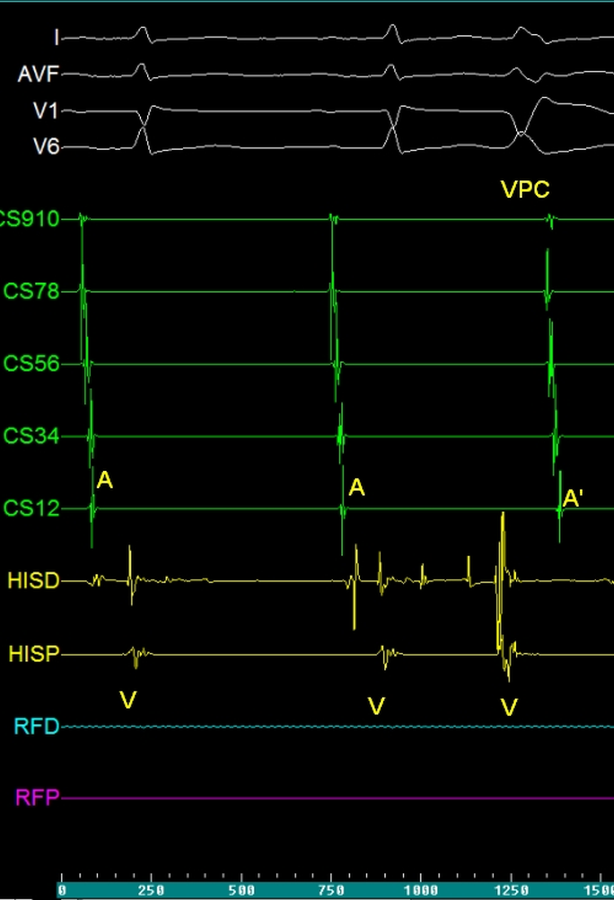 EP tracing of ventricular premature complex