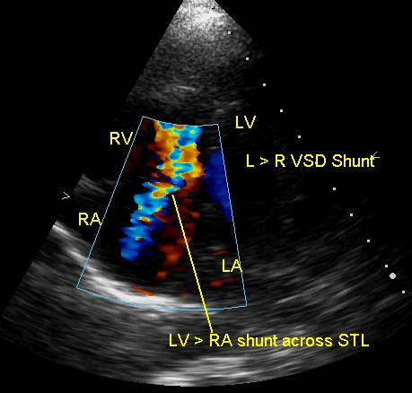 LV - RA shunt in perimembranous VSD across STL fenestration
