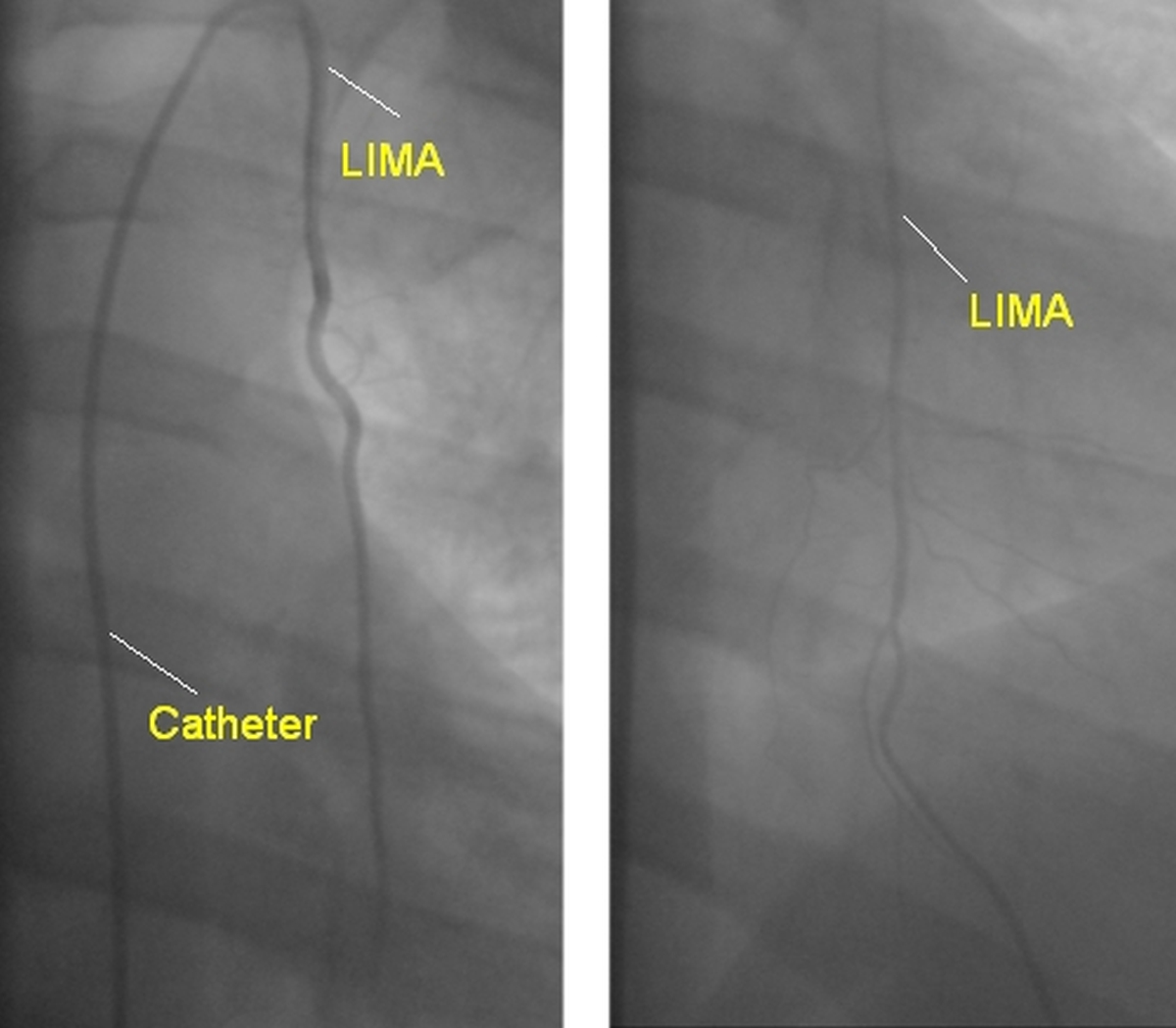 Left internal mammary artery (LIMA) angiogram