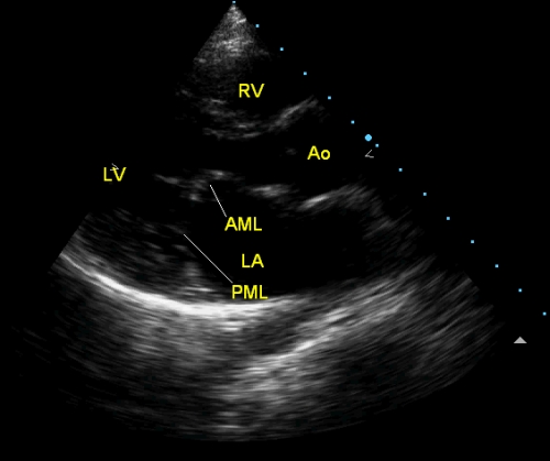 Rheumatic mitral stenosis - echocardiogram in PLAX view