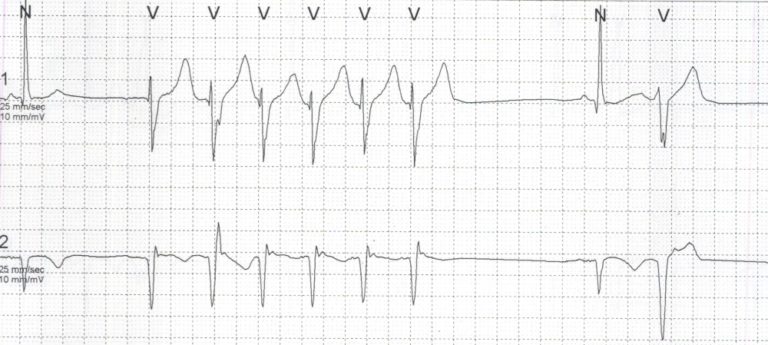 Polymorphic VPC and NSVT on Holter