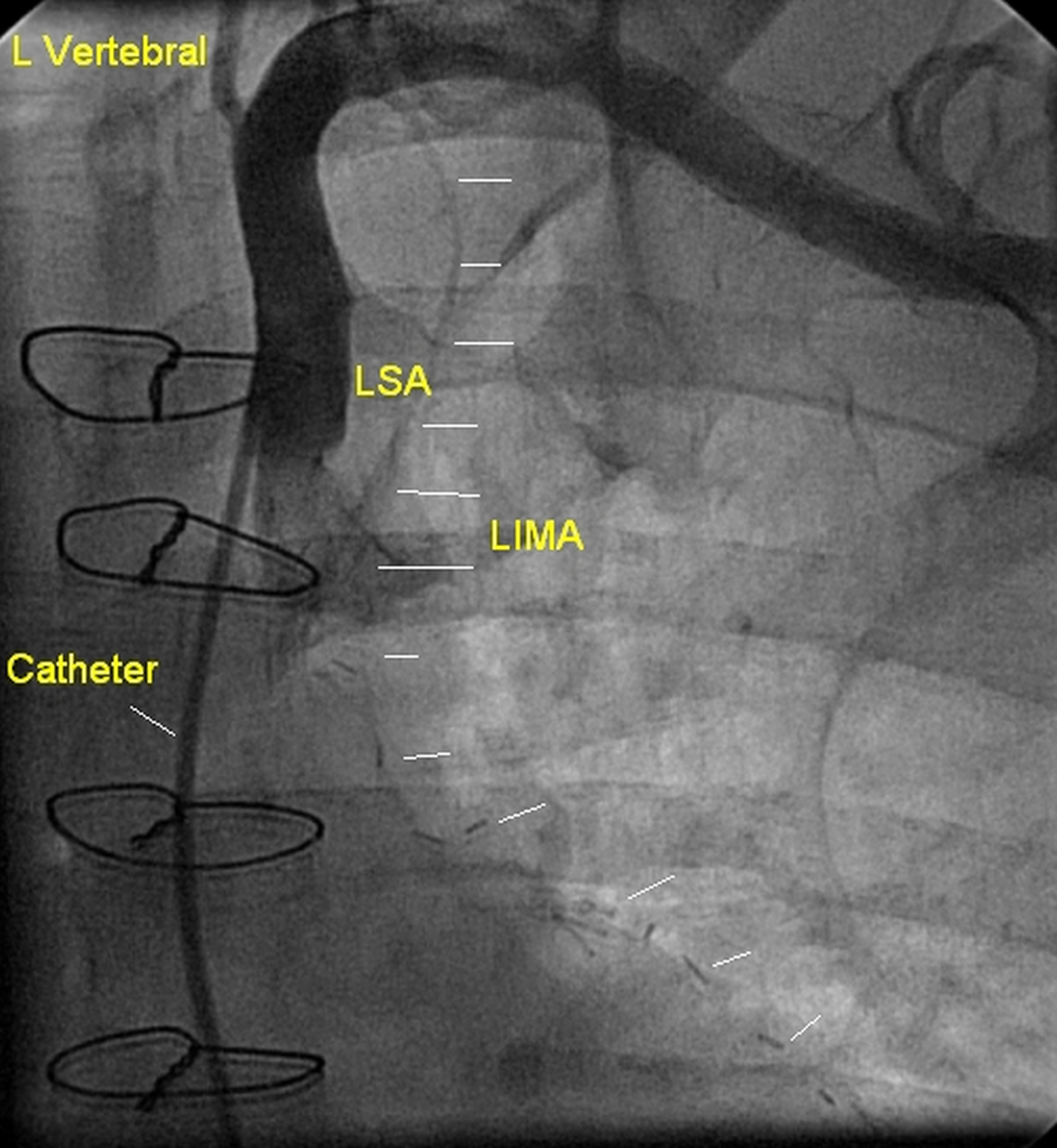 Occluded left internal mammary artery (LIMA) graft